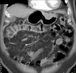 Bulky Gastric Cancer With Ulceration- Multiple Renderings - CTisus CT Scan