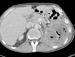 Perforated Gastric Mass - CTisus CT Scan