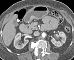 Inflammatory Polyp Simulates A Carcinoma - CTisus CT Scan