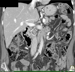 Lack of Gastric Distention Limits Study - CTisus CT Scan