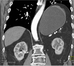 Subtle Tumor in Gastric Fundus Was Biopsy Proven Adenocarcinoma - CTisus CT Scan