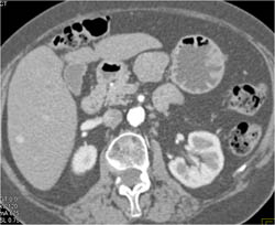 GIST Tumor - CTisus CT Scan