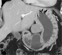 GIST Tumor - CTisus CT Scan