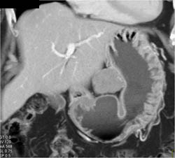 GIST Tumor - CTisus CT Scan