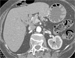 GIST Tumor - CTisus CT Scan