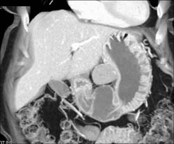 GIST Tumor - CTisus CT Scan