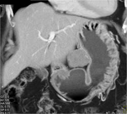 GIST Tumor - CTisus CT Scan