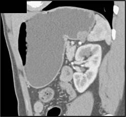 2 Cm GIST Tumor - CTisus CT Scan