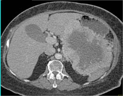 Ulcerating GIST Tumor With Pneumatosis Bowel - CTisus CT Scan