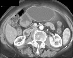 Antral Carcinoma - CTisus CT Scan