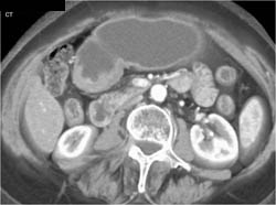 Antral Carcinoma - CTisus CT Scan