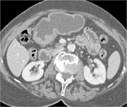 Antral Carcinoma - CTisus CT Scan