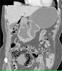 Antral Carcinoma - CTisus CT Scan