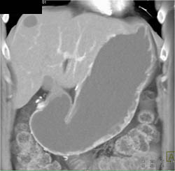 Glomus Tumor - CTisus CT Scan