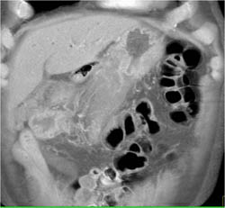 Gastric Cancer With Perigastric Spread in 3D - CTisus CT Scan