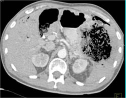 Ulcerated GIST Tumor - CTisus CT Scan