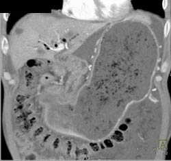 Antral Carcinoma - CTisus CT Scan