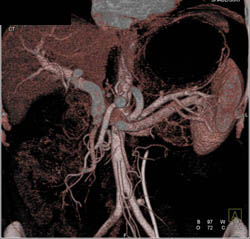 Antral Carcinoma - CTisus CT Scan