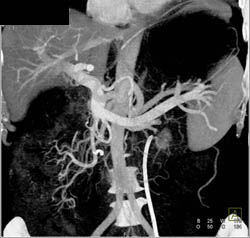 Antral Carcinoma - CTisus CT Scan