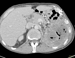 Left Upper Quadrant Abscess Within Necrotic Tumor - CTisus CT Scan