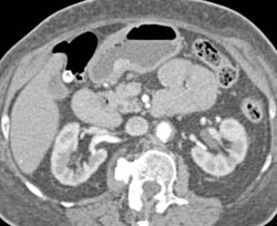 Antral Carcinoma- See Subtle Enhancing Lesion - CTisus CT Scan