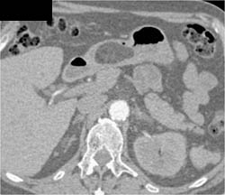 Gastric and Duodenal Lipoma - CTisus CT Scan