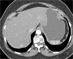 GIST Tumor - CTisus CT Scan