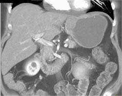 GIST Tumor - CTisus CT Scan