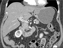 GIST Tumor - CTisus CT Scan