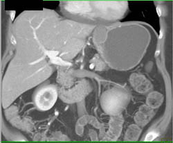 GIST Tumor - CTisus CT Scan