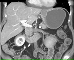 GIST Tumor - CTisus CT Scan