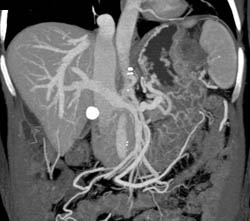 GIST Tumor With Ulceration - CTisus CT Scan