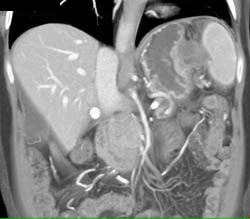 GIST Tumor With Ulceration - CTisus CT Scan