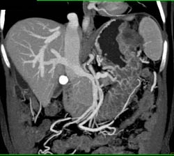 GIST Tumor With Ulceration - CTisus CT Scan