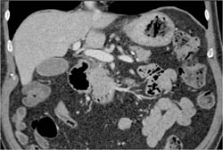 Gastric Adenocarcinoma - CTisus CT Scan