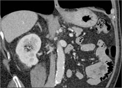 Gastric Adenocarcinoma - CTisus CT Scan