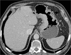 Gastric Adenocarcinoma - CTisus CT Scan