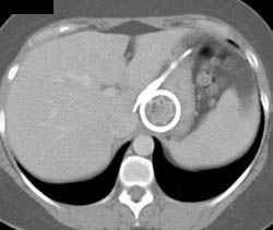 Vanguard Device at Gastroesophageal (GE) Junction for Weight Loss Surgery - CTisus CT Scan