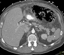 Necrotizing Gastritis - CTisus CT Scan