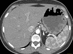 Gastric Polyps in Familial Polyposis With Desmoid Tumor - CTisus CT Scan