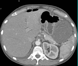 Desmoid Tumor Simulates A Gastric Tumor - CTisus CT Scan