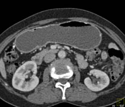 Antral Carcinoma - CTisus CT Scan