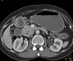 Antral Carcinoma - CTisus CT Scan