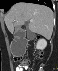 Antral Carcinoma - CTisus CT Scan