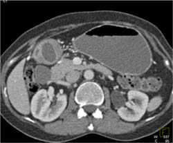 Antral Carcinoma - CTisus CT Scan