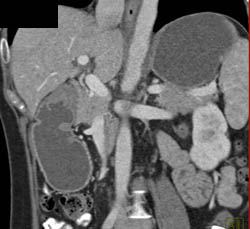 Antral Carcinoma - CTisus CT Scan