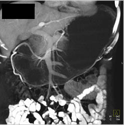 Antral Carcinoma - CTisus CT Scan