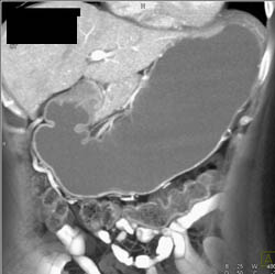 Antral Carcinoma - CTisus CT Scan