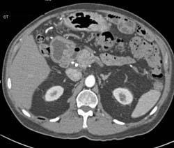 Gastritis - CTisus CT Scan