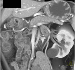 Gastritis - CTisus CT Scan